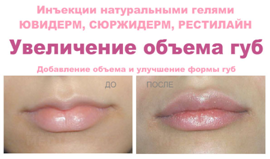 Juvederm, Surgiderm, Рестилайн